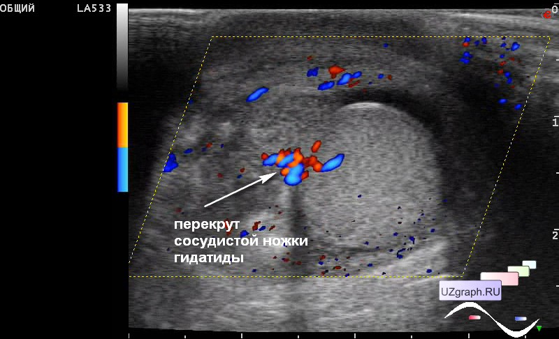 Перекрут яичка. Перекрут гидатиды УЗИ картина. Гидатида яичка операция. Гидатида придатка яичка на УЗИ. Перекрут гидатиды яичка УЗИ.